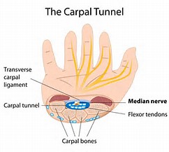 Acupuncture for Carpel Tunnel Syndrome